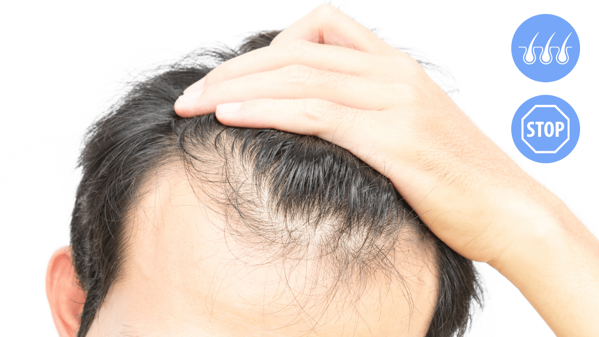 stop hair loss